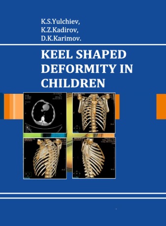 Keel shaped deformity in children