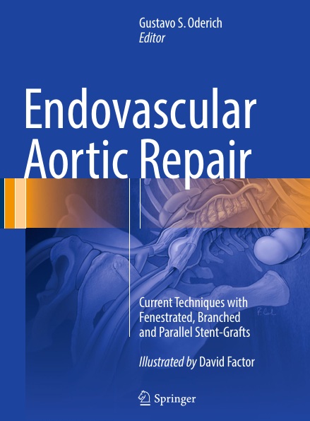 Endovascular  Aortic Repair