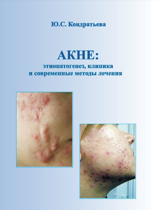 Акне: этиопатогенез, клиника и современные методы лечения