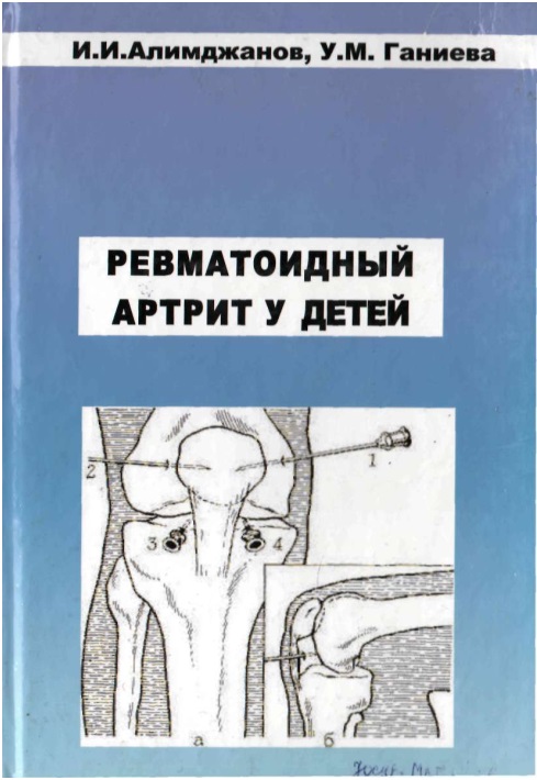 Ревматоидный артрит у детей