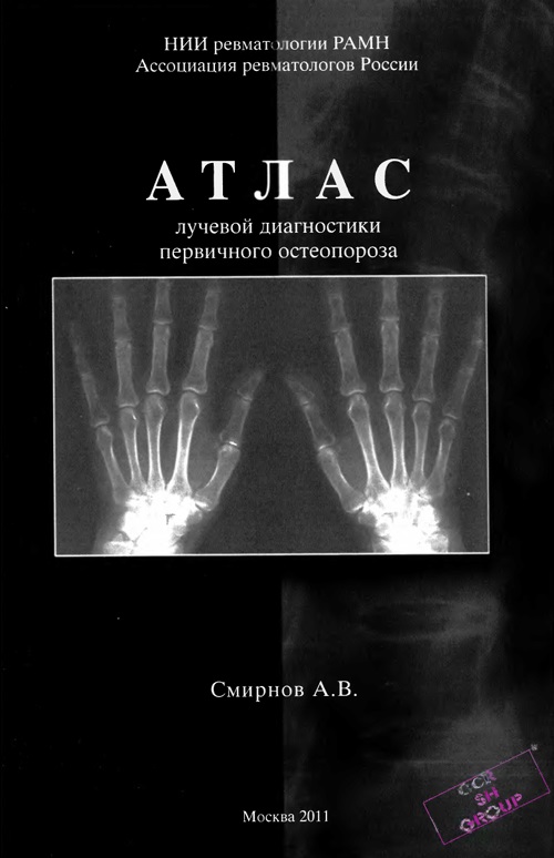 Атлас лучевой диагностики первичного остеопороза
