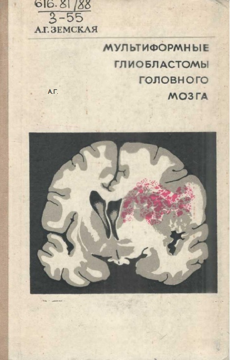 Мультиформные глиобластомы головного мозга