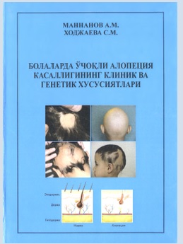 Болаларда ўчоқли алопеция касаллигининг клиник ва генетик хусусиятлари