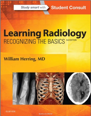 Learning Radiology recognizing the basics