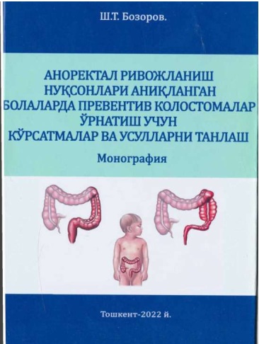 Аноректал ривожланиш нуқсонлари аниқланган болаларда превентив колостомалар ўрнатиш ўчун кўрсатмалар ва усулларни танлаш