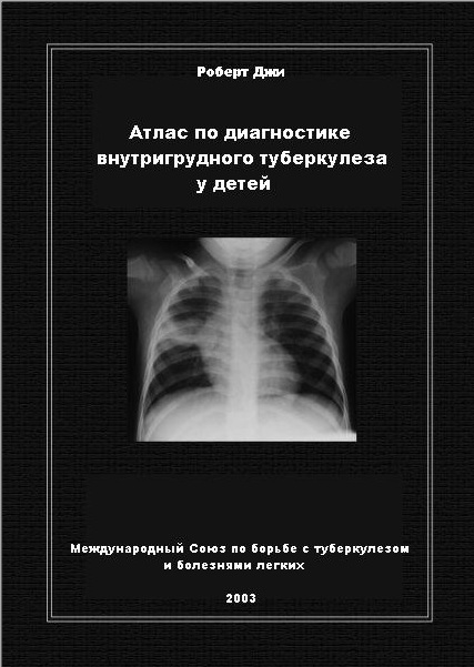 Атлас по диагностике внутригрудного туберкулеза у детей