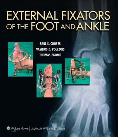 External fixators of the foot and ankle