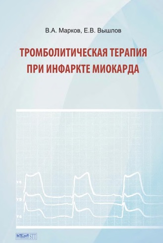Тромболитическая терапия при  инфаркте миокарда
