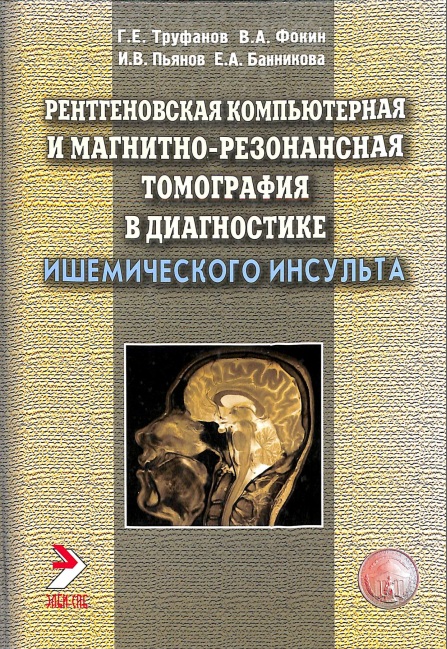 Рентгеновская компютерная и магнитно-резонансная томография в диагностике ишемического инсульта