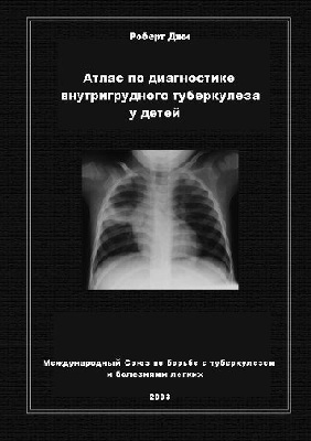 Aтлас по диагностике внутригрудного туберкулеза у детей