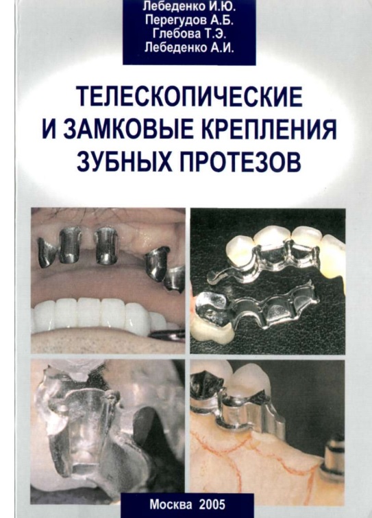 Телескопические и замковые крепления зубных протезов