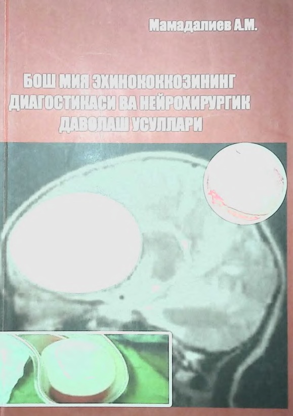 Бош мия эхинококкознинг диагностикаси ва нейрохирургик даволаш усуллари