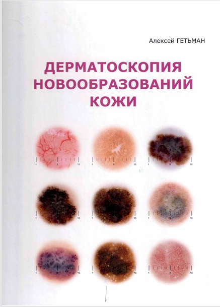Дерматоскопия новообразований кожи