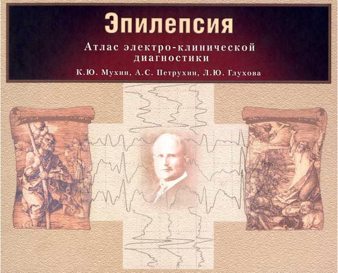 Эпилепсия