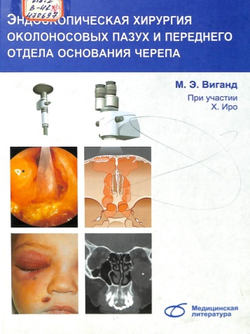 Эндоскопическая хирургия околоиосовых пазух и переднего отдела основания черепа