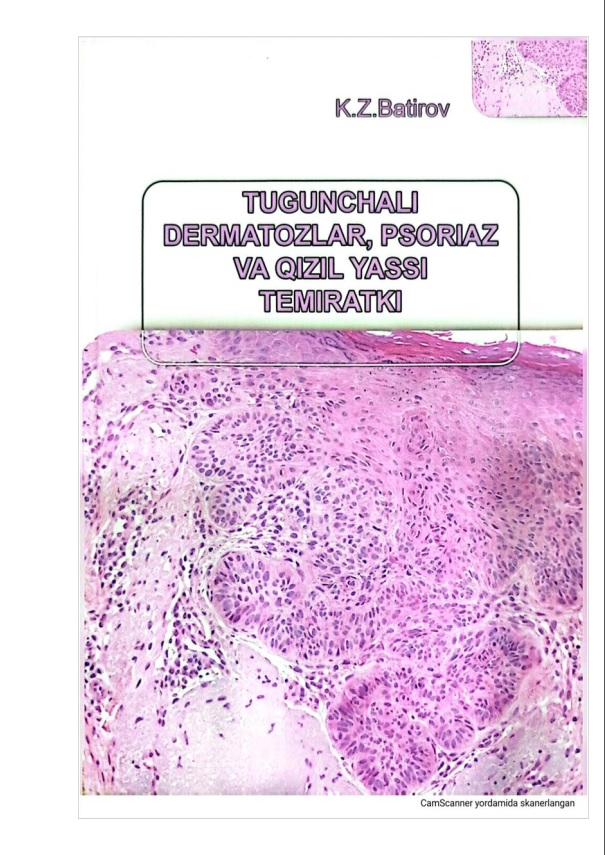 Tugunchali dermatozlar, psoriaz va qizil yassi temiratki